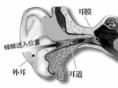 蟑螂爬进耳朵内怎么办，如何才能有效防治？ 