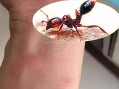 被蚂蚁咬怎么处理？ 