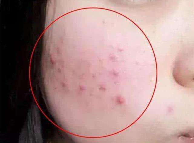 螨虫咬的包