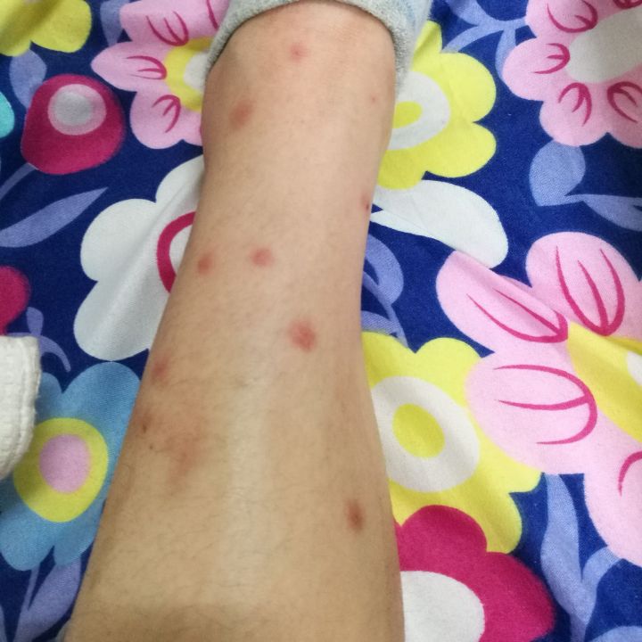 小腿被跳蚤叮咬图