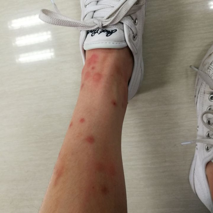 跳蚤咬后的症状