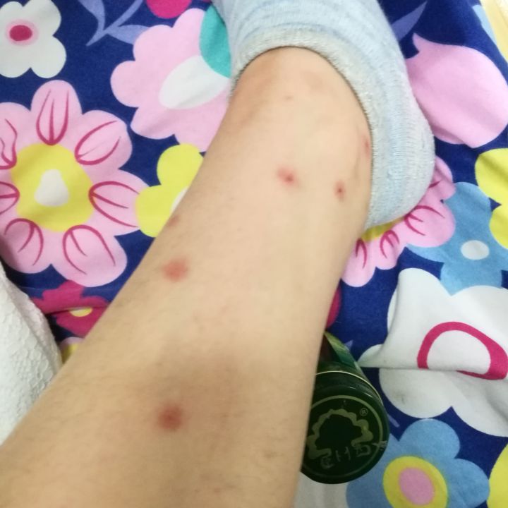 跳蚤叮咬图