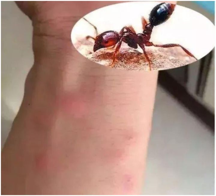 被蚂蚁咬伤